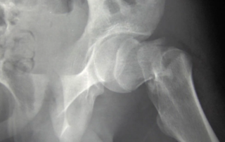 xray of hip bone