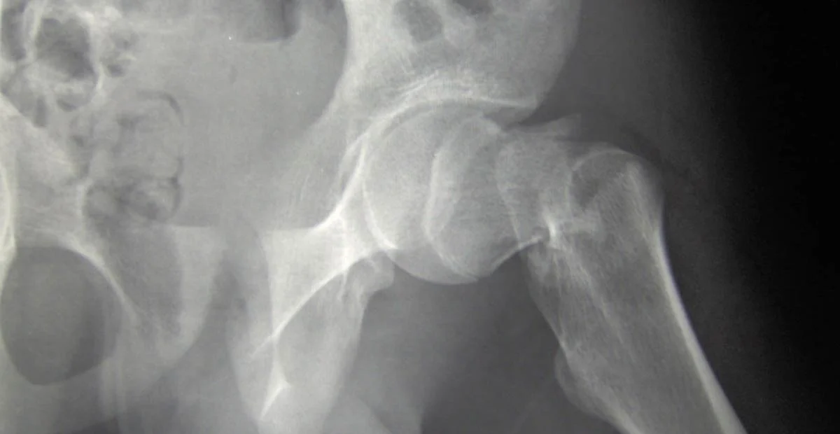 Read article 'Outsmart Osteoporosis: Tips for Injury Prevention'