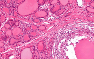 Microscopic view of hypothyroidism cell