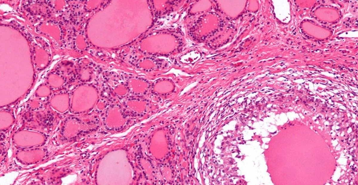 Read article 'The Great Masquerader: Hypothyroidism'