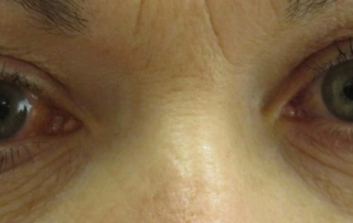 Closeup of eyes affected by glaucoma.