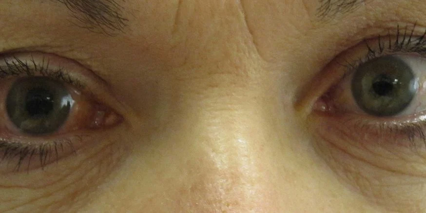 Read article 'Glaucoma: The Silent Thief'